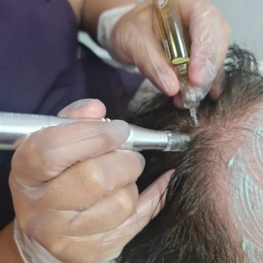 Microneedling capilar